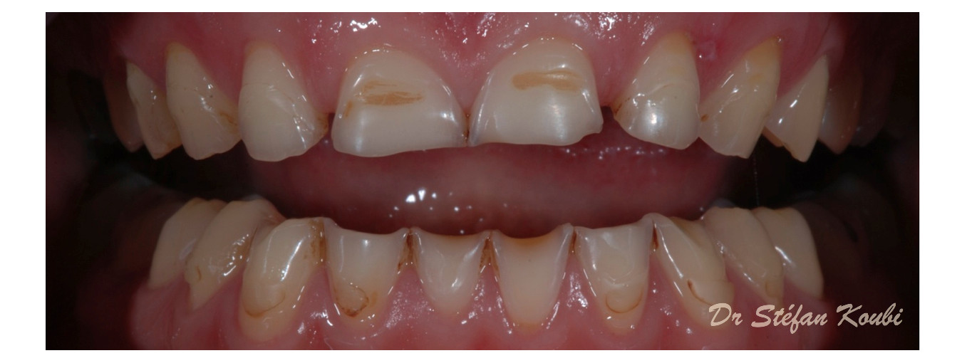 veneers and crowns / Dr Stéfan Koubi